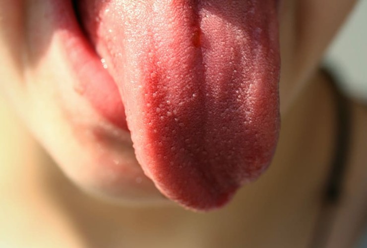El picor en la lengua